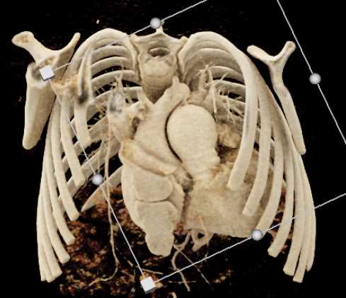 Dilated Main Pulmonary Artery - CTisus CT Scan