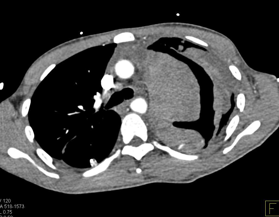 Pleural Based Hematoma - CTisus CT Scan