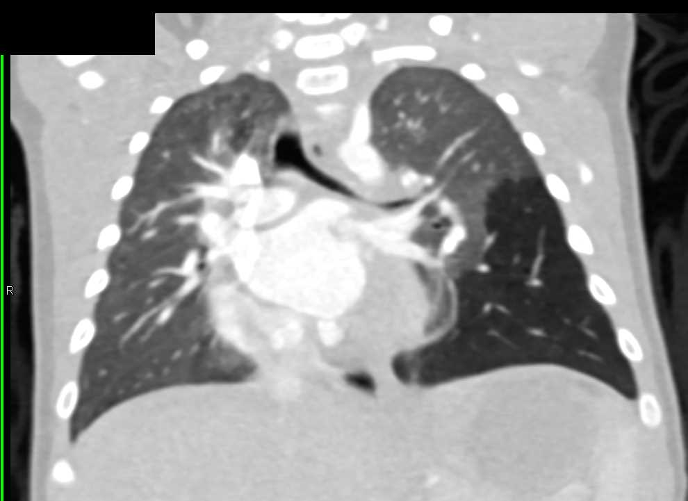 Hyperlucency Left Lower Lung - CTisus CT Scan