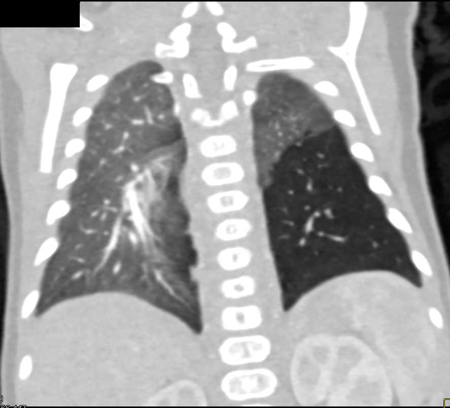 Hyperlucency Left Lower Lung - CTisus CT Scan