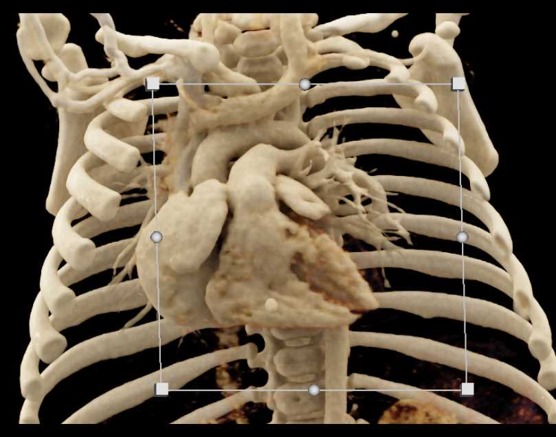 Hyperlucency Left Lower Lung - CTisus CT Scan