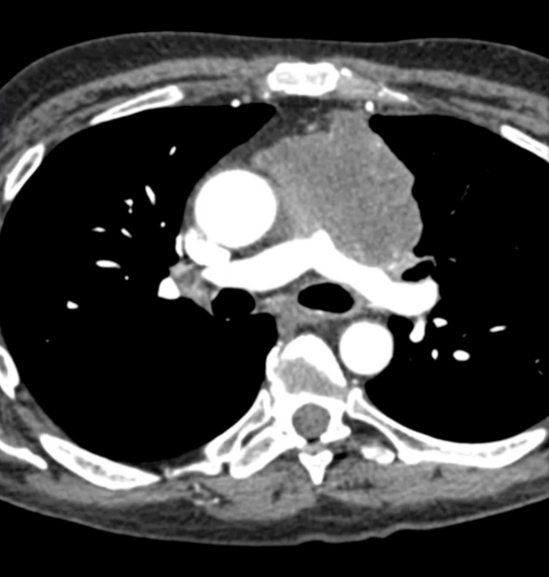 Thymic Carcinoma - CTisus CT Scan