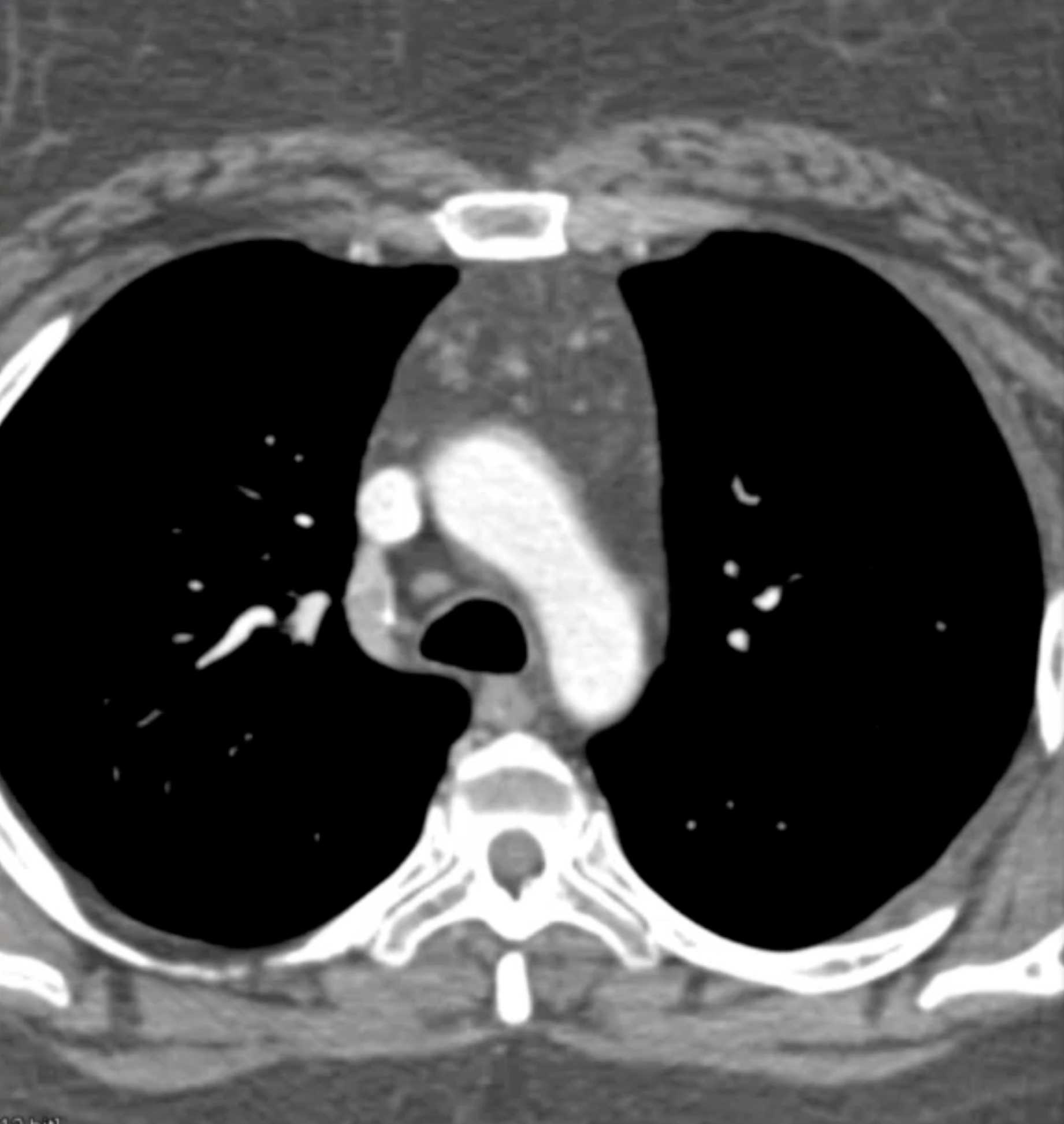 Thymolipoma - CTisus CT Scan