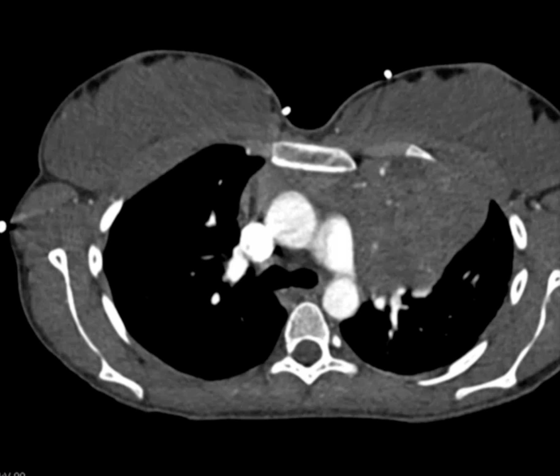 Hodgkin Lymphoma - CTisus CT Scan
