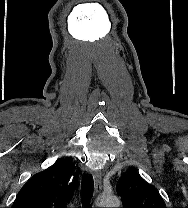 Thyroid Cancer Invades the Spine - CTisus CT Scan