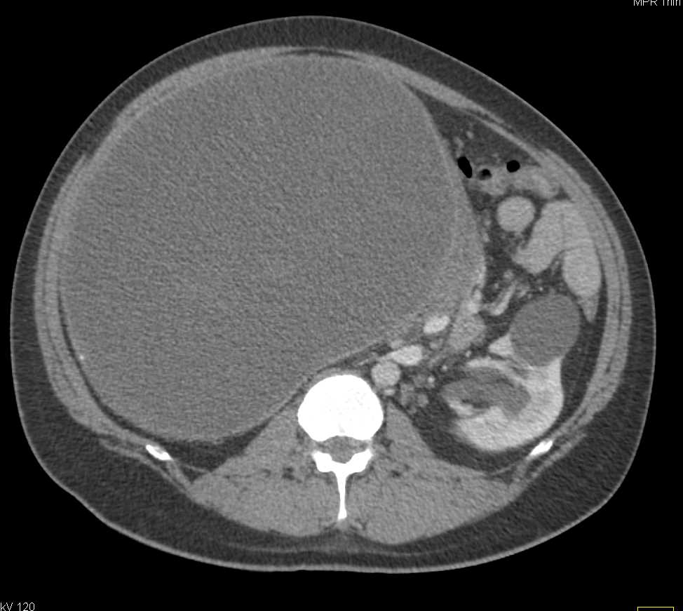 Mediastinal Teratoma - CTisus CT Scan