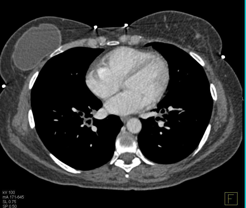 Amyloidosis of the Airway - CTisus CT Scan