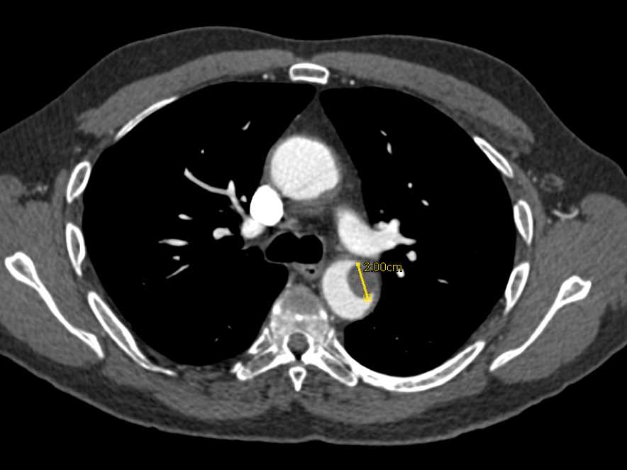 Clot vs Tumor in Aorta in Patient with Pleomorphic Sarcoma - CTisus CT Scan