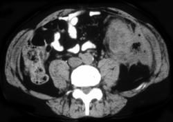 Perforated Colon Cancer - CTisus CT Scan