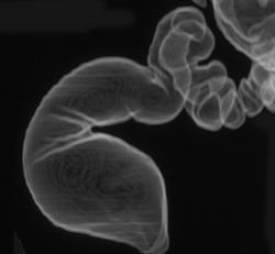Virtual Colonoscopy With Volume Rendering - CTisus CT Scan