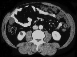 Carcinomatosis - CTisus CT Scan
