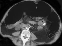Ischemic Colon W/portal Venous Air - CTisus CT Scan