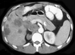 Liver Metastases & Cutaneous Cysts in Gardner Syndrome - CTisus CT Scan
