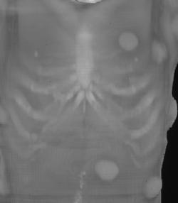 Gardner Syndrome - CTisus CT Scan