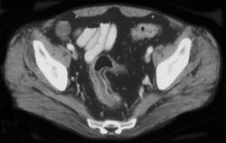 Ulcerative Colitis - CTisus CT Scan