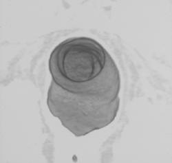Virtual Colonoscopy - CTisus CT Scan