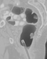 Stool Simulating Rectal Polyps - CTisus CT Scan