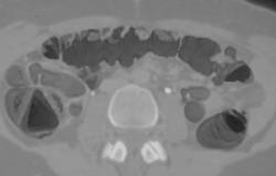 Stool Simulating Polyps on A Virtual Colonoscopy - CTisus CT Scan