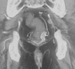 Rectal Cancer - CTisus CT Scan
