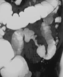 Apple Core Cancer - CTisus CT Scan