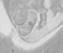 Virtual Imaging of the Cecum and Appendix - CTisus CT Scan
