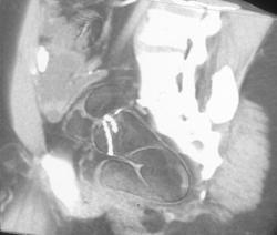 Virtual Colonoscopy of An Anastomosis in the Sigmoid Colon - CTisus CT Scan