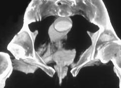 Foley Catheter Perforates Bladder and Goes Into the Rectum - CTisus CT Scan