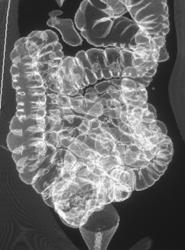 Virtual Colonoscopy With 2 Rendering Techniques - CTisus CT Scan