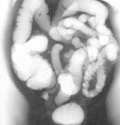 Virtual Colonoscopy With Diverticular Disease - CTisus CT Scan