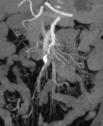Stenosis of SMA - CTisus CT Scan