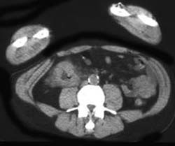 PET/CT of Colon Cancer - CTisus CT Scan