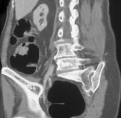 Virtual Colonoscopy of A Colon Cancer - CTisus CT Scan