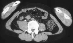 PET/CT of Recurrent Colon Cancer in Mesentery - CTisus CT Scan