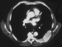 Metastatic Colon Cancer to the Rib (PET/CT) - CTisus CT Scan