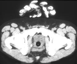 PET/CT Recurrent Colon Cancer Near Right Obturator Internus Muscle - CTisus CT Scan