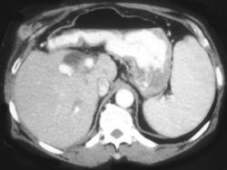 PET/CT Recurrent Colon Cancer in Abdominal Wall - CTisus CT Scan