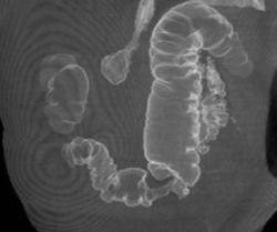 Apple Core Lesion on Virtual Colonoscopy - CTisus CT Scan