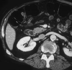 Polyp in Hepatic Flexure - CTisus CT Scan