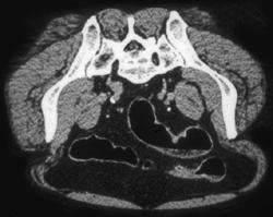 Prone Images as Part of A Virtual Colonoscopic Exam - CTisus CT Scan