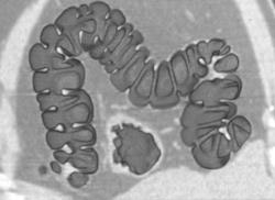 Virtual Colon (normal) - CTisus CT Scan