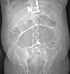 Dilated Colon - CTisus CT Scan