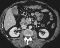 Poorly Prepped Virtual Colon - CTisus CT Scan