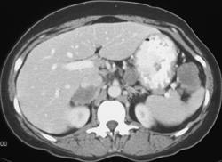 Lung Cancer With Adrenal and Splenic Metastases - CTisus CT Scan