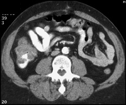 Cecal Cancer - CTisus CT Scan