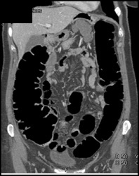 Air Distended Colon for Virtual Colon - CTisus CT Scan