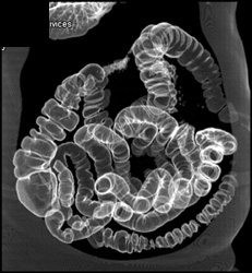 Normal Virtual Colon and Air in Small Bowel - CTisus CT Scan