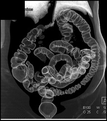 Virtual Colon - CTisus CT Scan