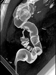 Colon Cancer on Virtual Colon- Two Renderings - CTisus CT Scan