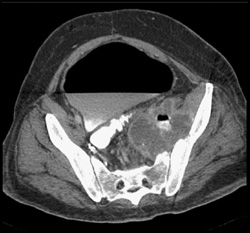 Perforated Colon With Abscess - CTisus CT Scan