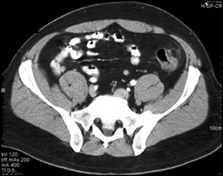Appendix Epiploica - CTisus CT Scan